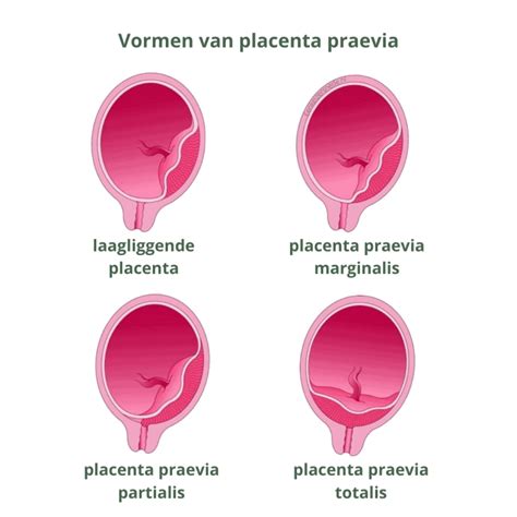 Schematische weergave van de verschillende vormen van placenta praevia ten opzichte van de baarmoedermond.