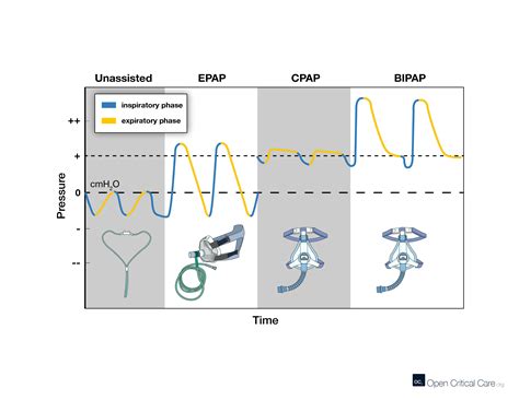 Schema van de verschillende ademhalingsondersteuningssystemen voor baby's (High Flow, CPAP, Beademing).