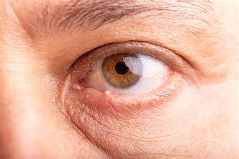 Een lam met een naar binnen gekruld ooglid.