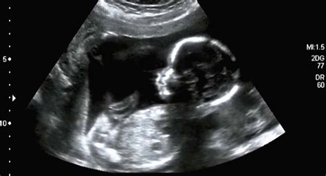 Illustratie van een 3D echo met gedetailleerde gezichtsstructuur van een baby