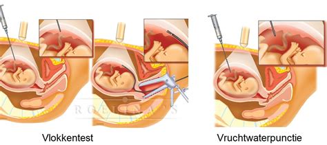 Diagram dat het verschil tussen NIPT, vlokkentest en vruchtwaterpunctie illustreert, inclusief risico's.