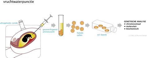 Illustratie van de procedure van een vruchtwaterpunctie.