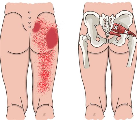 illustratie van bekkeninstabiliteit en de betrokken spieren