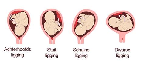 schematische weergave van een baby in stuitligging en dwarsligging in de baarmoeder