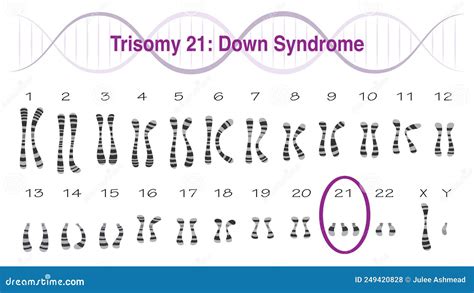 Visuele weergave van chromosomen, met nadruk op de trisomie bij Down-, Edwards- en Patausyndroom.