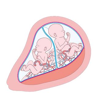 Illustratie van monochoriale en dichoriale tweelingzwangerschappen met bijbehorende placenta-structuren.