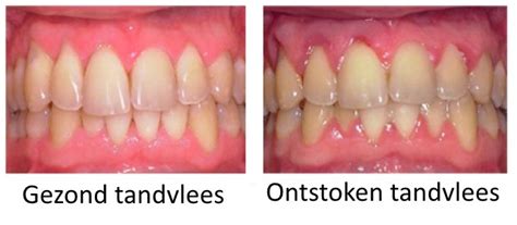 Illustratie van gezond en ontstoken tandvlees bij zwangere vrouwen