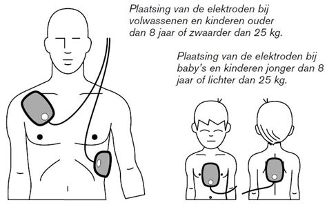 Diagram dat de correcte plaatsing van AED-pads op de borstkas van een kind illustreert.