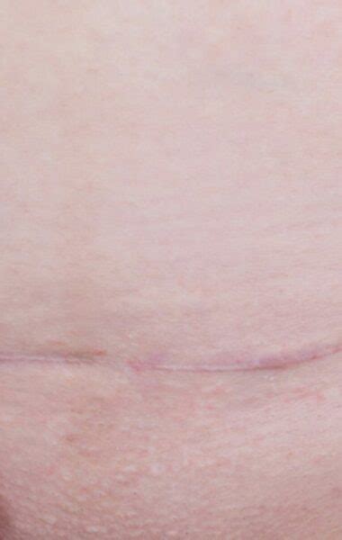 Een close-up van een genezend keizersnede litteken, met een zachte focus op de textuur.