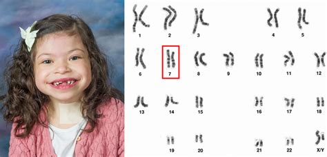 Collage van gezichtskenmerken geassocieerd met Wiedemann-Steiner syndroom